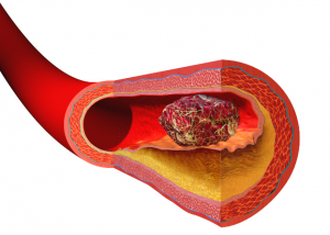 A thrombus totally blocks (occludes) blood flow from activated coagulation factors