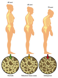 aging osteoporotic bones