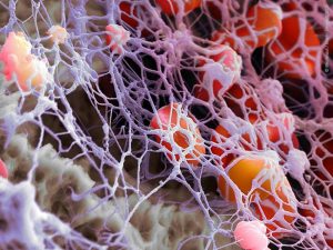 the thrombus clot composed of an aggregate of activated platelets in a rich fibrin polymer mesh 