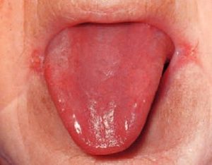 glossitis (re tongue) and angular cheilitis are symptoms of iron deficiency