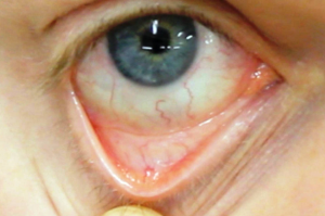 anemia with (pallid) poor conjunctival perfusion 