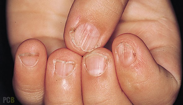 Brittle Nails: Causes and Treatment Tips